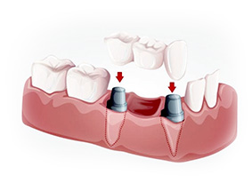 Имплантация